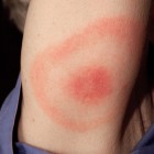 Eritema típico de la enfermedad de Lyme