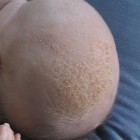 «<a href="http://commons.wikimedia.org/wiki/File:Baby_With_Cradle_Cap.jpg#mediaviewer/File:Baby_With_Cradle_Cap.jpg">Baby With Cradle Cap</a>». Disponible bajo la licencia <a href="http://creativecommons.org/licenses/by-sa/3.0/" title="Creative Commons Attribution-Share Alike 3.0<p></p>">CC BY-SA 3.0</a> vía <a href="//commons.wikimedia.org/wiki/">Wikimedia Commons</a>