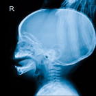 Radiografía de un cráneo