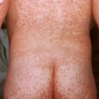 Niño con sarampión (fuente: CDC)