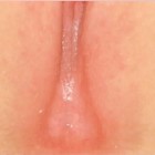 sinequia vulvar