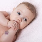 Niño con un hemangioma en el brazo