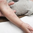 Herpes zoster en un brazo