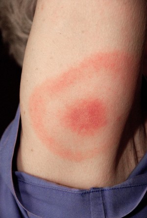 Eritema típico de la enfermedad de Lyme