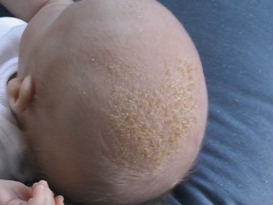 «<a href="http://commons.wikimedia.org/wiki/File:Baby_With_Cradle_Cap.jpg#mediaviewer/File:Baby_With_Cradle_Cap.jpg">Baby With Cradle Cap</a>». Disponible bajo la licencia <a href="http://creativecommons.org/licenses/by-sa/3.0/" title="Creative Commons Attribution-Share Alike 3.0<p></p>">CC BY-SA 3.0</a> vía <a href="//commons.wikimedia.org/wiki/">Wikimedia Commons</a>