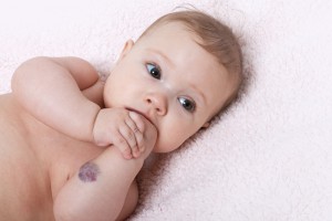 Niño con un hemangioma en el brazo